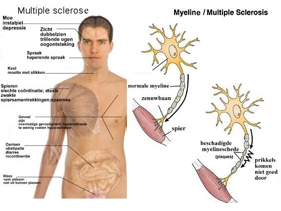 Behandeling multiple sclerose (MS)